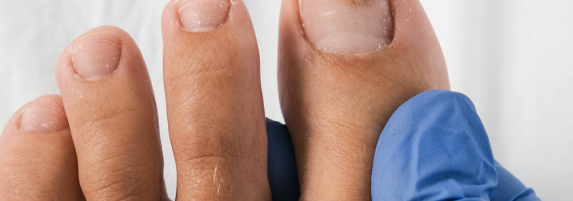 Champignon sur les ongles