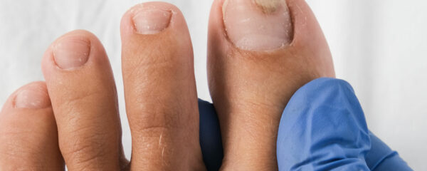 Champignon sur les ongles