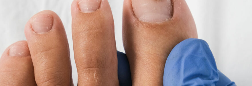 Champignon sur les ongles